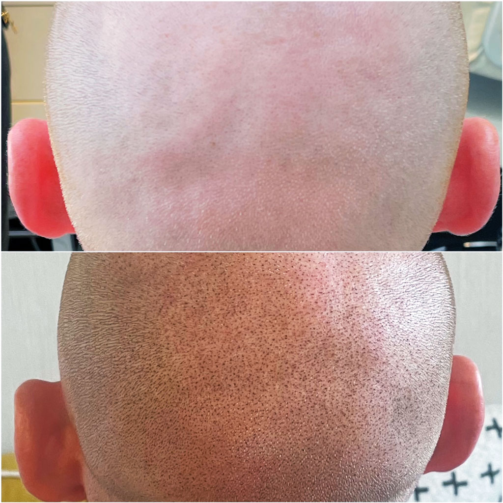 Tricopigmentation crâne rasé – avant / après naturel · Institut Moko, Colmar