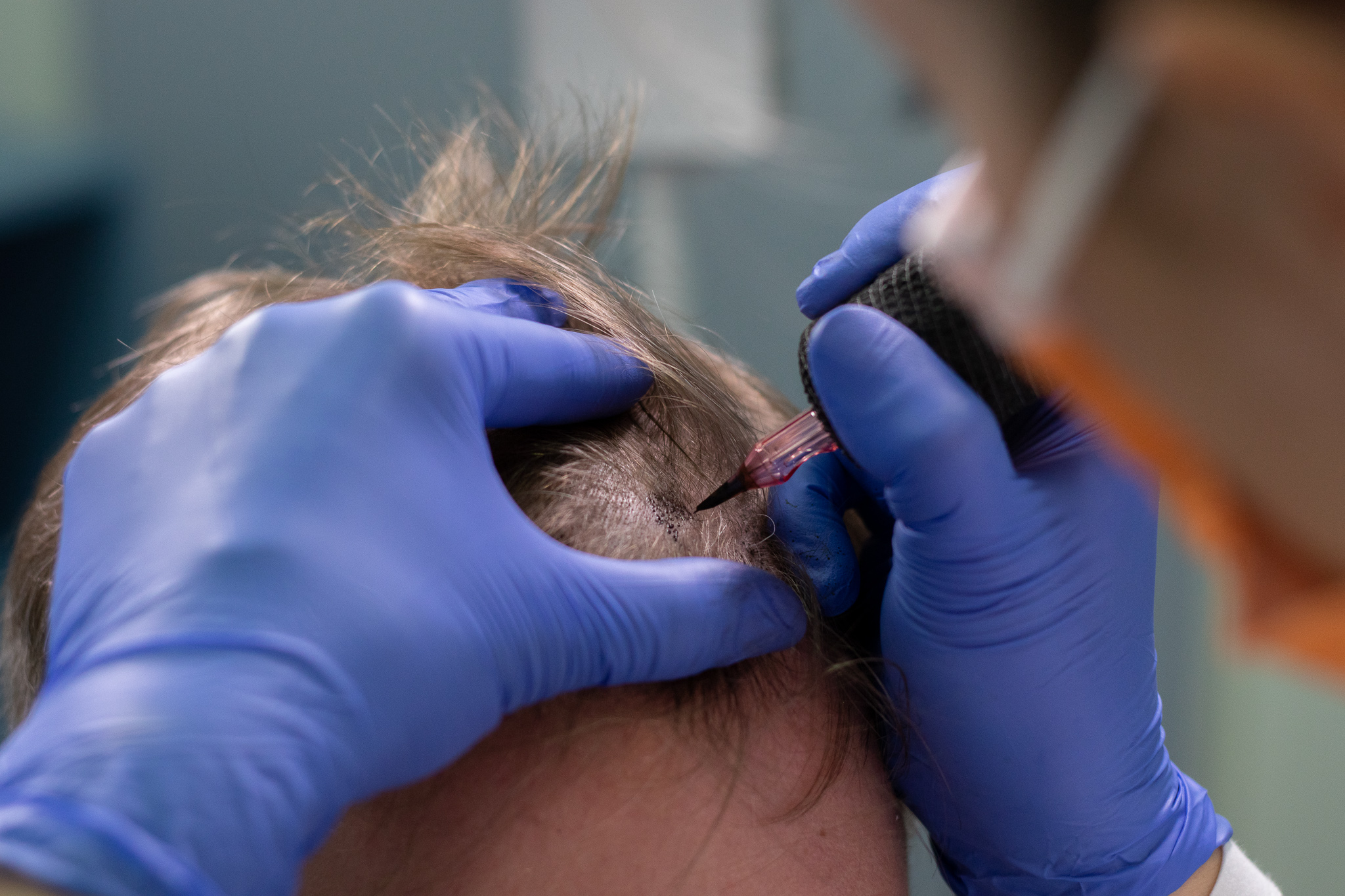Tricopigmentation – zoom aiguille, effet densité · Institut Moko, Colmar
