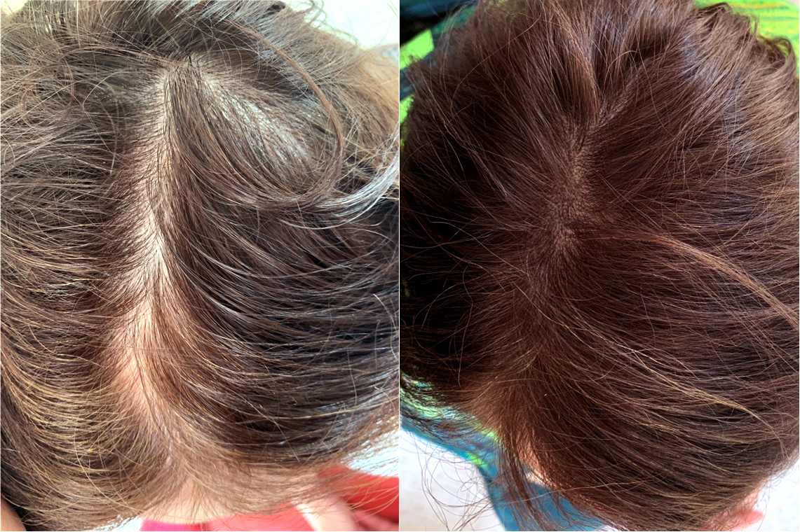 Tricopigmentation densité – avant / après cheveux longs · Institut Moko
