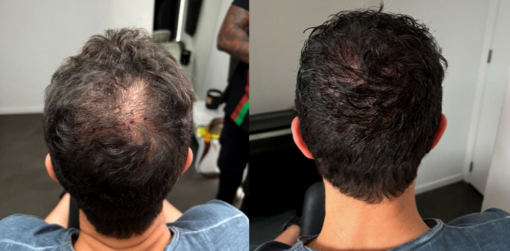 Tricopigmentation densité – avant / après cheveux courts · Institut Moko