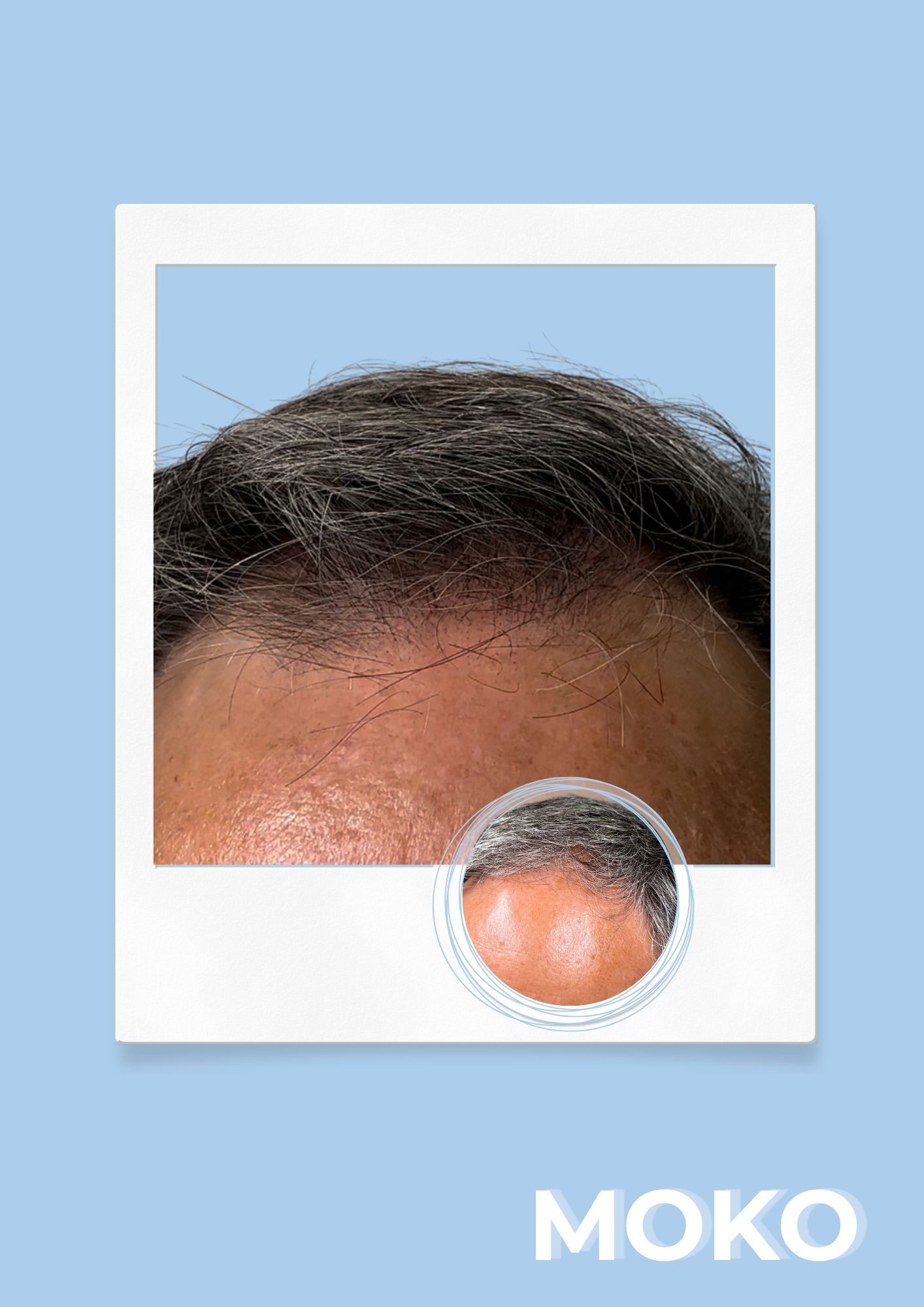Tricopigmentation densité · Institut Moko, Turckheim (Colmar), Alsace