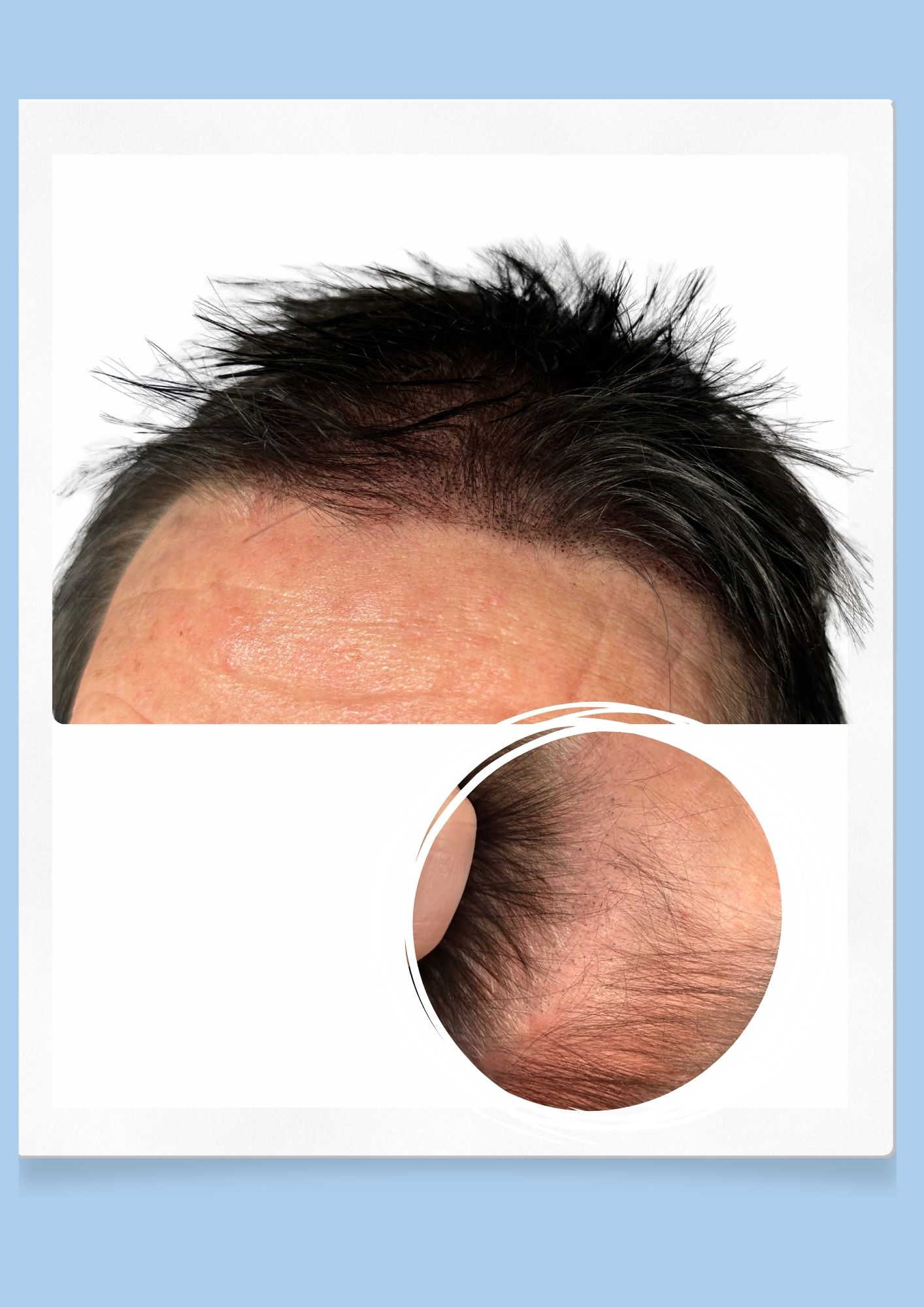 Tricopigmentation densité · Institut Moko, Turckheim (Colmar), Alsace