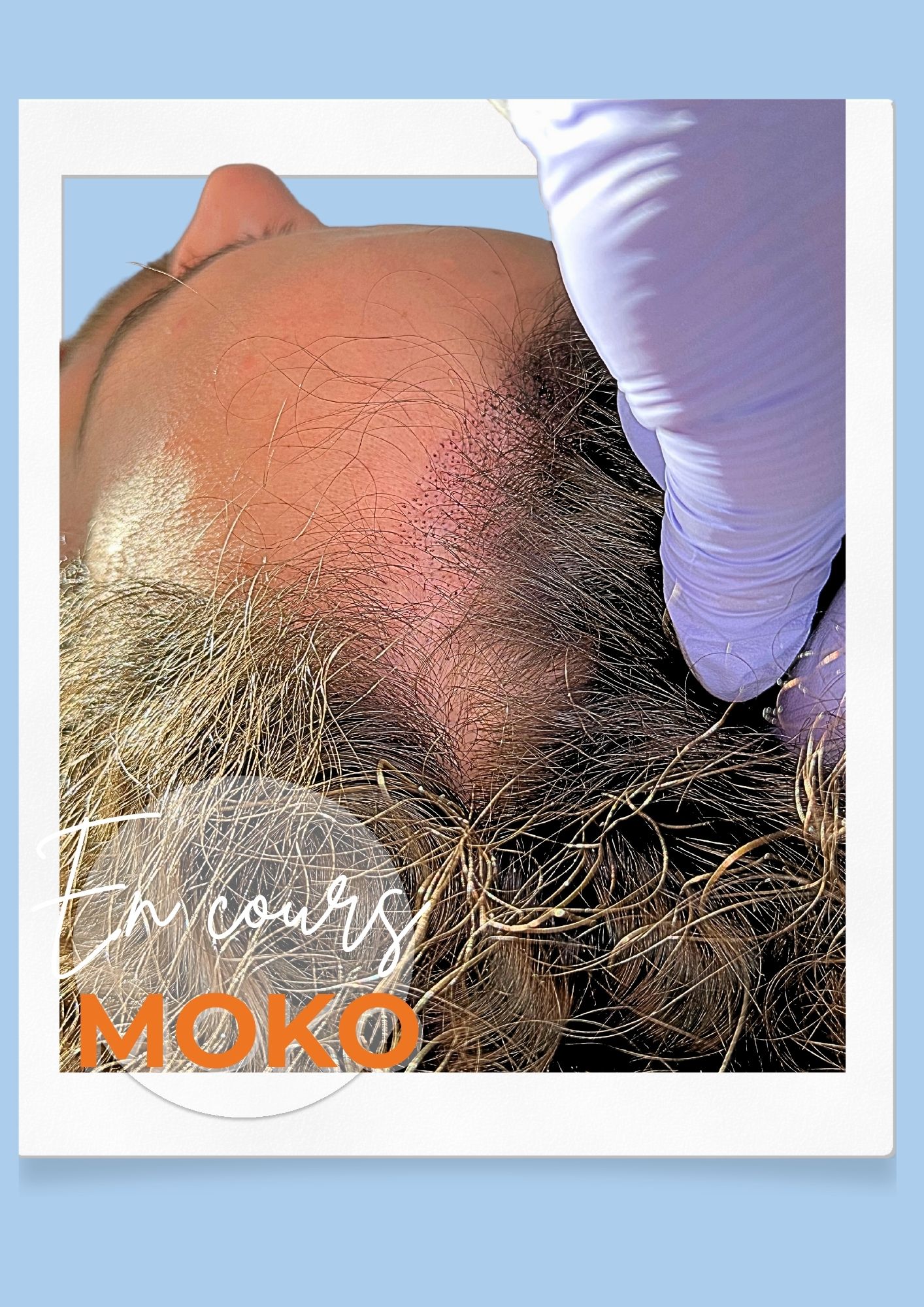 Tricopigmentation densité · Institut Moko, Turckheim (Colmar), Alsace