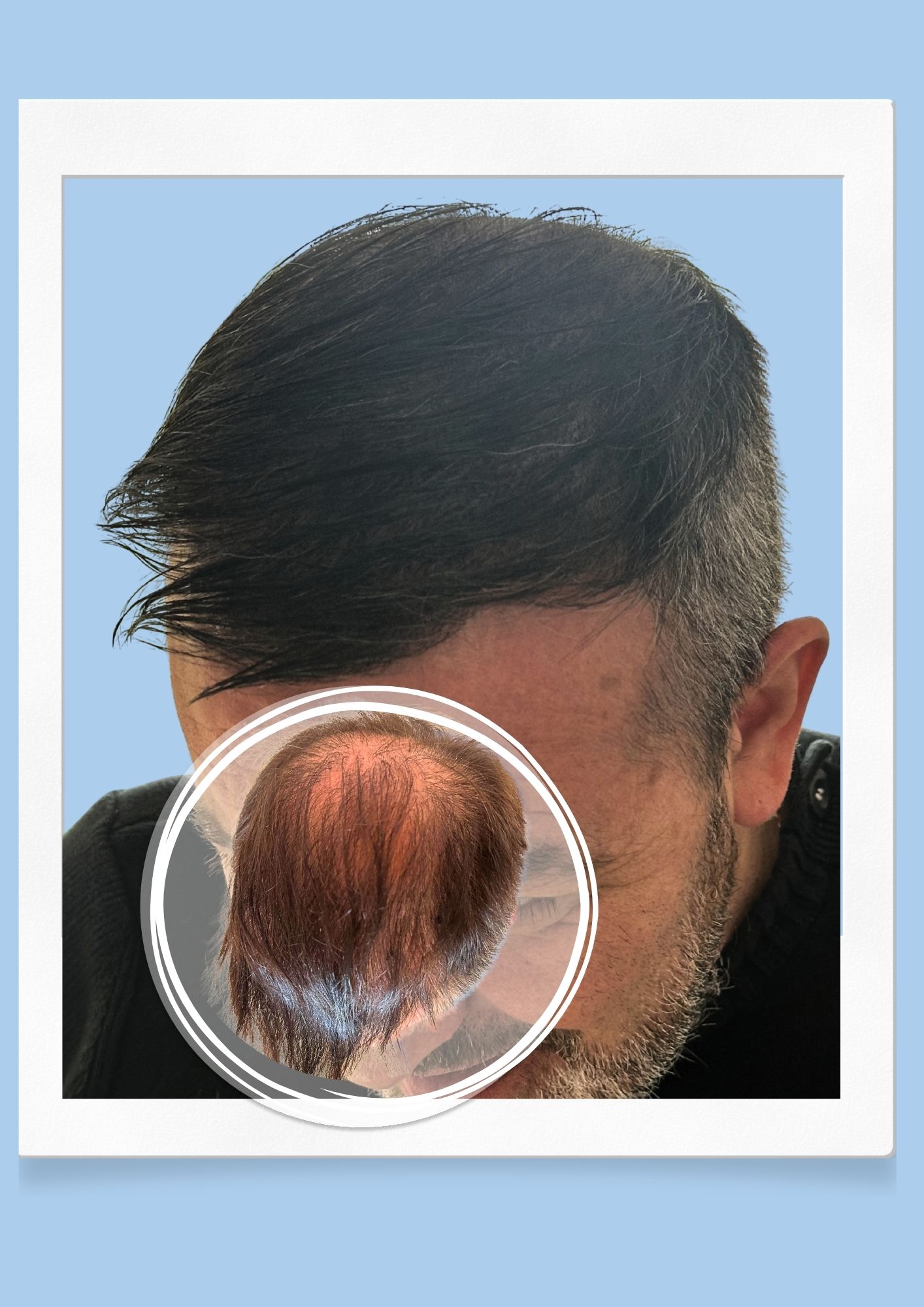 Tricopigmentation densité · Institut Moko, Turckheim (Colmar), Alsace