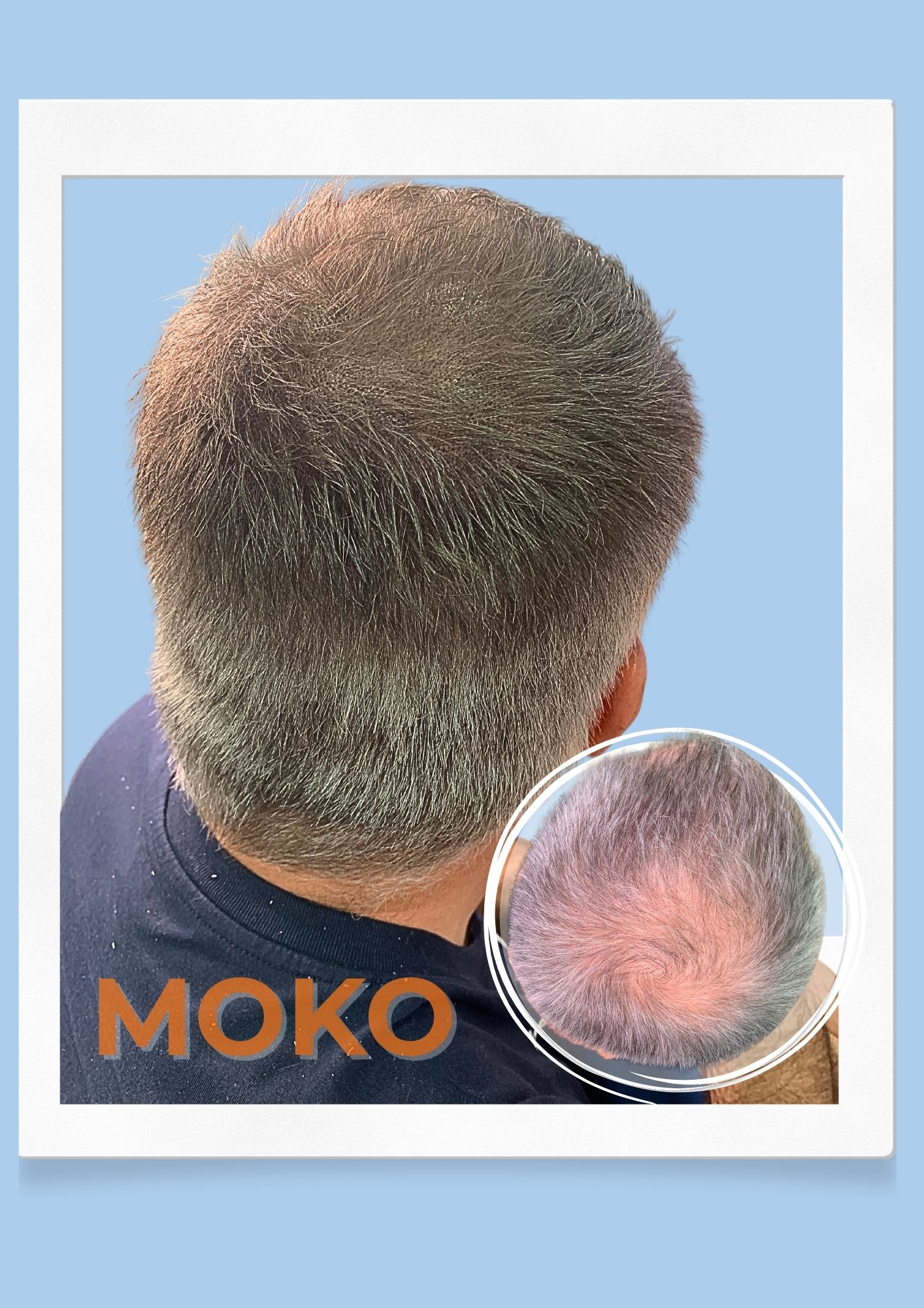 Tricopigmentation densité · Institut Moko, Turckheim (Colmar), Alsace