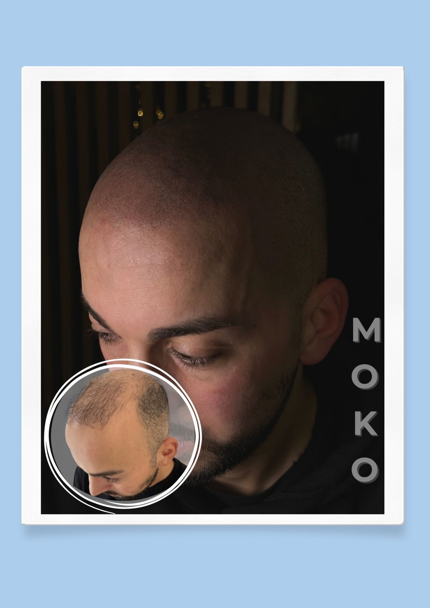 Tricopigmentation effet crâne rasé · Institut Moko, Turckheim (Colmar), Alsace