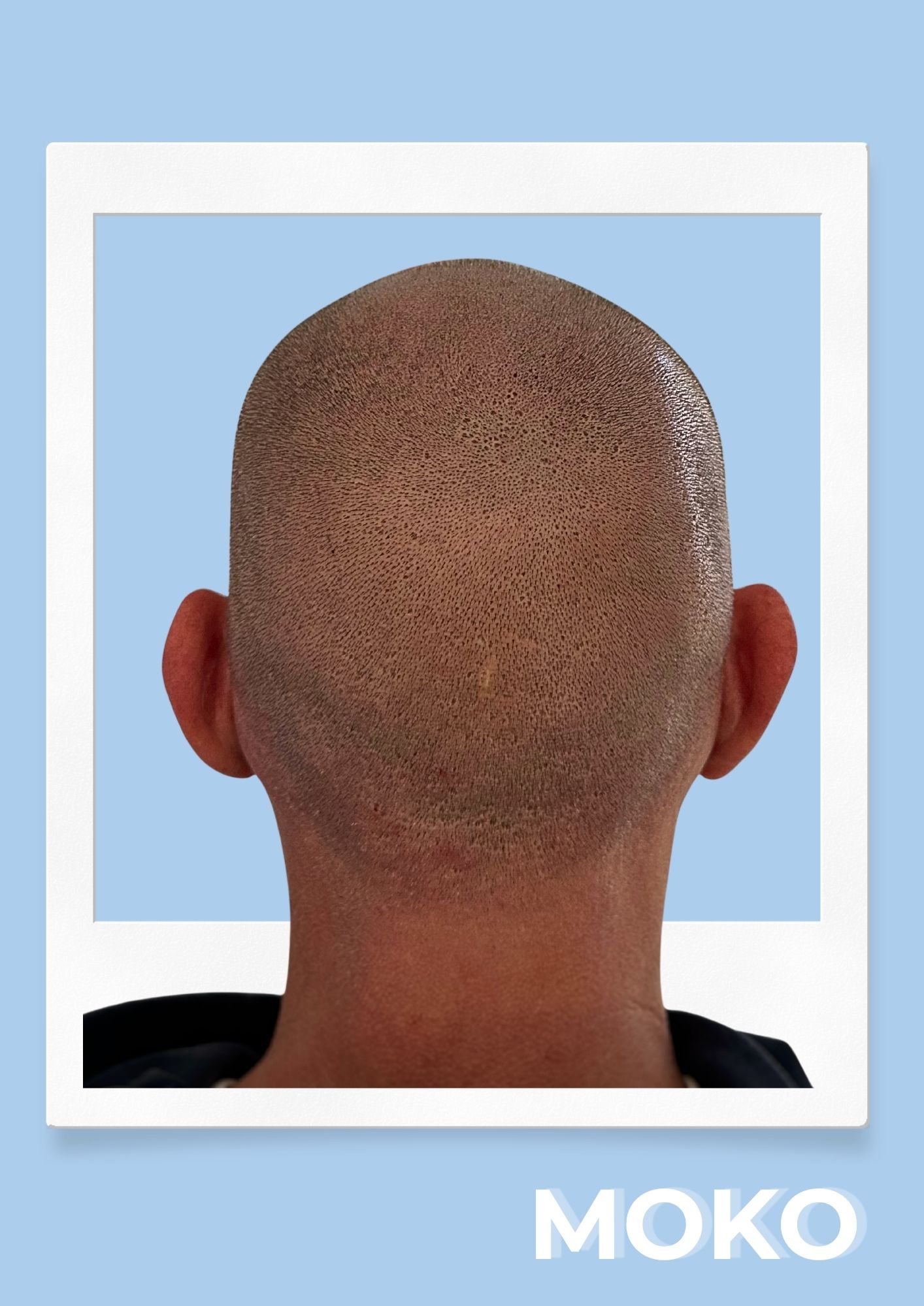 Tricopigmentation effet crâne rasé · Institut Moko, Turckheim (Colmar), Alsace