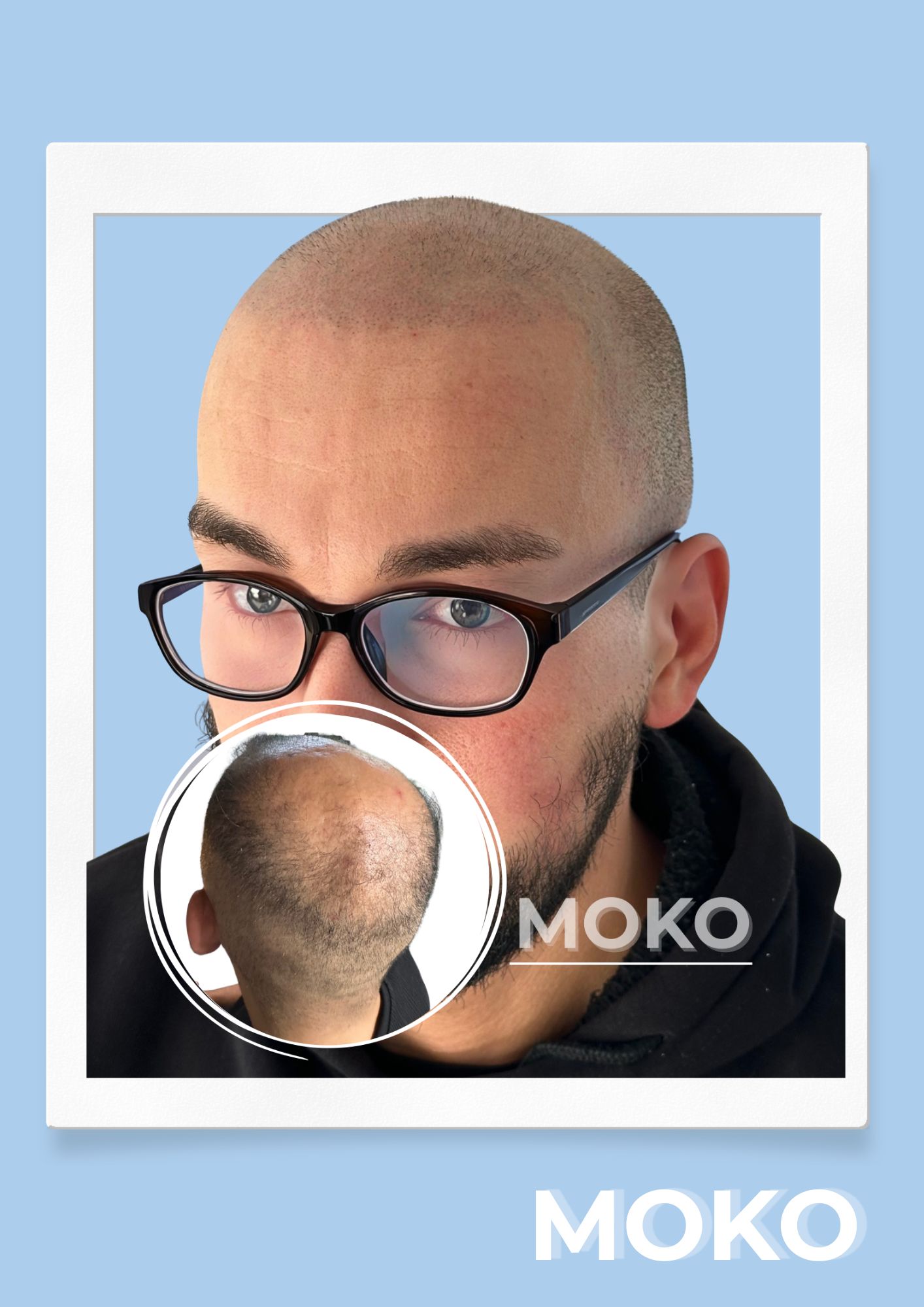 Tricopigmentation effet crâne rasé · Institut Moko, Turckheim (Colmar), Alsace